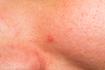 close-up photo of a women face with acne