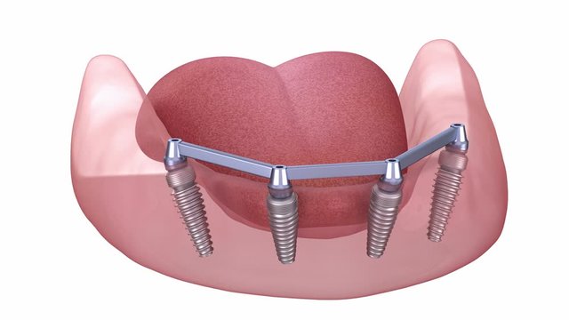 Removable Mandibular prosthesis with gum All on 4 system supported by implants. Medically accurate 3D animation of human teeth and dentures