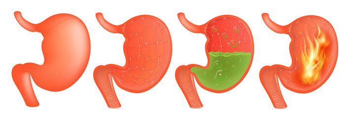 Vector Medical illustration of realistic stomach outside and inside. Gastritis and acid reflux, indigestion and stomach pain problems.