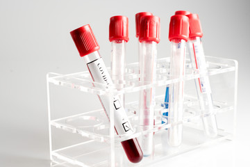 blood samples tubes test in the doctor's office.To detect  Coronavirus,Covid-19 In the hand, With...