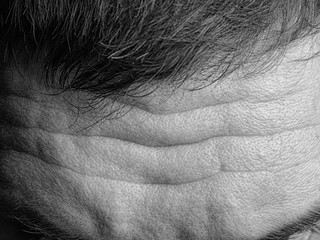 Black and white photo of a male forehead with wrinkles and porous skin