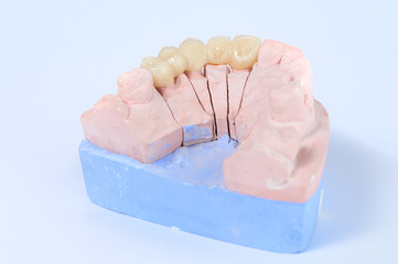 Ceramic tooth crown on plaster model