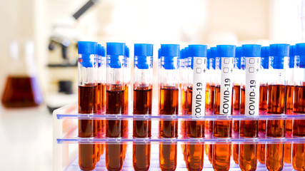 The blood samples of Covid-19 to test for the coronavirus