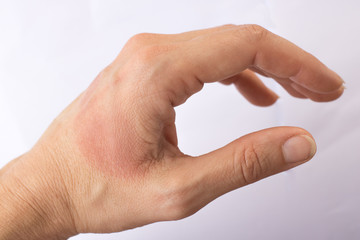 Woman's hand covered red painful burn spot on the back of the hand next to the thumb. Isolated on white background