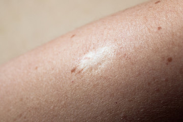 Fototapeta premium BCG vaccination mark on a woman's arm