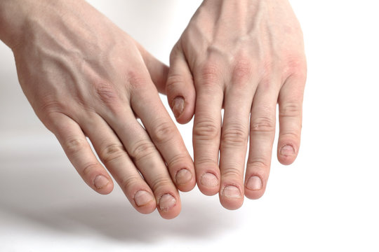 Man nail damage. Bitten nails. Man manicure. Nail plate problems. Man hands . Isolated on a white background.