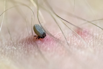 Ixodes sucks blood on human skin