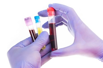 Medical worker in gloves holding a test tubes with blood and urine samples. Corona. Coronavirus...