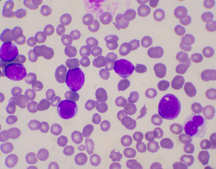 Immature white blood cells in blood smear.
