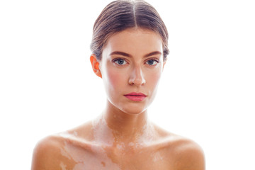 beautiful young brunette woman with vitiligo disease isolated on white positive smiling, model...