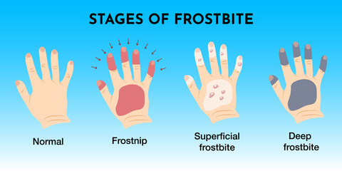 Medical frostbite stage and first aid infographic. Frozen hands with fingers. Vector illustration for web design.