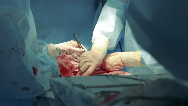 Surgeons are sewing up patient's stomach