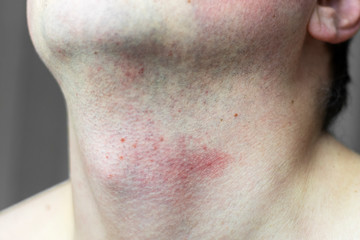 Skin irritation on male neck after shaving. Close-up photo. - obrazy, fototapety, plakaty