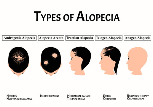 Types of alopecia. Bald spot, baldness, Alopecia mesotherapy. Causes of baldness. Infographics. Vector illustration on isolated background.