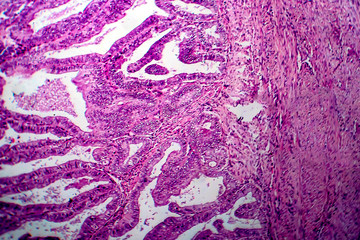 Endometrial adenocarcinoma, light micrograph
