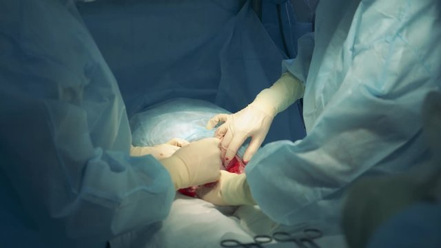 Surgeons are holding a caesarean section on a patient