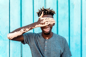 Young man with vitiligo and sky blue background