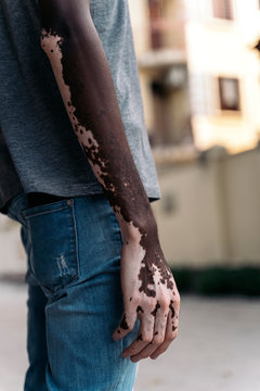 Man arm with vitiligo condition, Depigmentation in brown skin