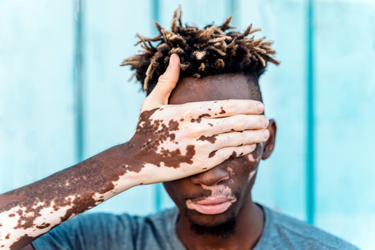 Young man with vitiligo and sky blue background