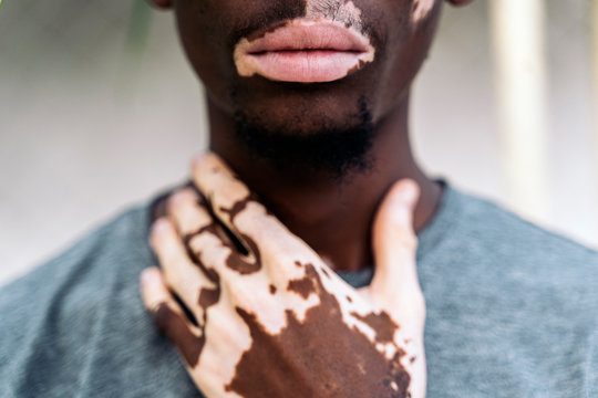 Midsection of young man with vitiligo