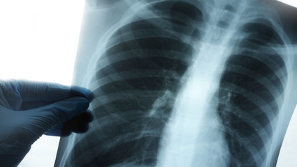 A x-ray of teenager lungs. Doctor look roentgen for diagnostic pneumonia covid-19. Concept coronavirus theme.