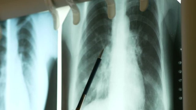 fluorography of coronavirus lungs of patients. pneumonia