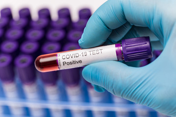Positive COVID-19 test tube and laboratory sample of blood testing for diagnosis new Corona virus...