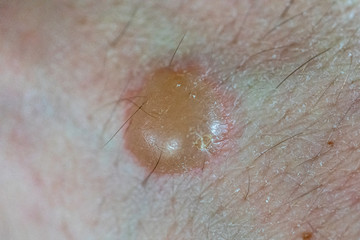 Clinical Photograph of a Second Degree Burn Sustained from a Drop of Hot Grease