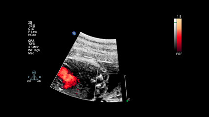 Ultrasound screen with fetal echocardiography