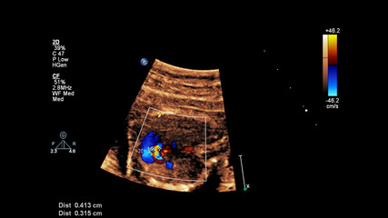 Ultrasound screen with fetal echocardiography