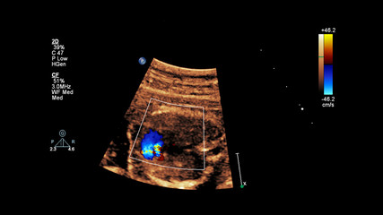 Ultrasound screen with fetal echocardiography