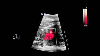 Ultrasound screen with fetal echocardiography