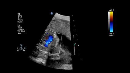 Ultrasound screen with fetal echocardiography