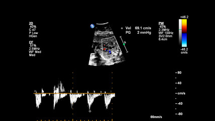 Ultrasound screen with fetal echocardiography