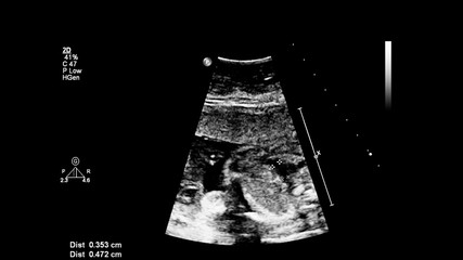 Ultrasound screen with fetal echocardiography