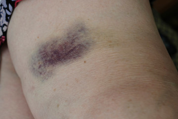 Fototapeta premium big bruise on the knife. Subcutaneous trauma on human skin, painful dark blue huge bruise on the female leg.