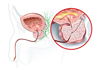 Benign prostatic hyperplasia (BPH), enlarged prostate with bladder, urethra and seminal vesicle, medical illustration