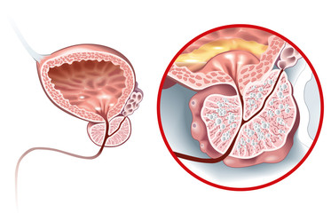 Benign prostatic hyperplasia (BPH), enlarged prostate with bladder, urethra and seminal vesicle, medical illustration