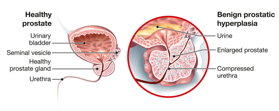 Benign prostatic hyperplasia (BPH), enlarged prostate with bladder, urethra and seminal vesicle, medical illustration