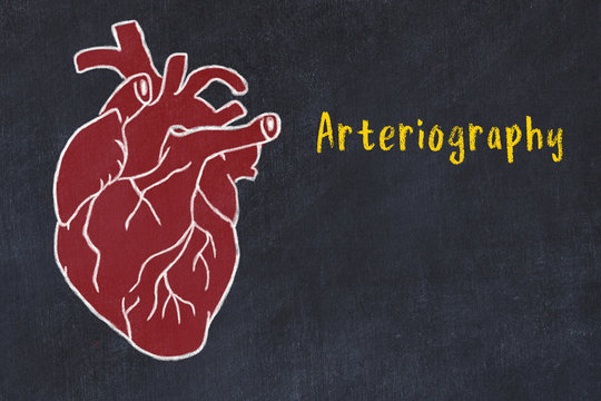 Concept Of Learning Cardiovascular System. Chalk Drawing Of Human Heart And Inscription Arteriography