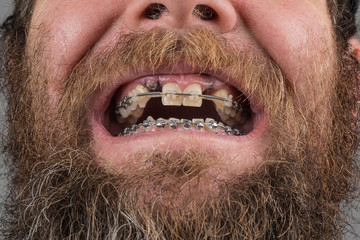 Two dental implants on upper jaw and metal braces on both rows of teeth. Lower braces seen with dented wire to align lower row of teeth, tooth number 3 and 4. Ortodontic accesories in mouth © Anze