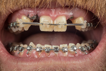 Two dental implants on upper jaw and metal braces on both rows of teeth. Lower braces seen with dented wire to align lower row of teeth, tooth number 3 and 4. Ortodontic accesories in mouth © Anze