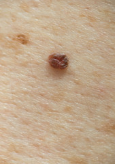 Mole on human skin