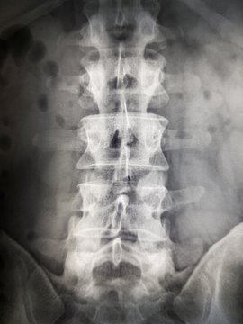 X-ray of the human spine