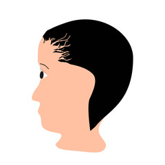Alopecia hair. Baldness of hair on the head. Traction alopecia. Infographics. Vector illustration on isolated background.