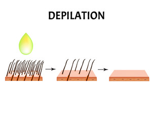 Hair depilation. Hair removal. Infographics. Vector illustration on isolated background.