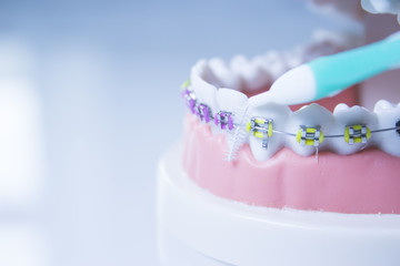 Model denture with metal orthodontics