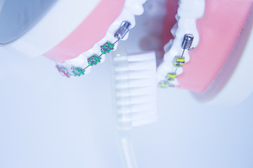 Model denture with metal orthodontics
