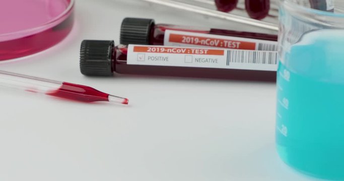 Dolly in shot of positive blood sample for COVID-19 test, laboratory sample of blood testing for diagnosis Corona virus infection, novel corona virus 2019, The pandemic infection concept