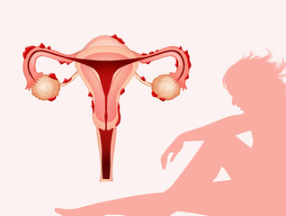 illustration of endometriosis